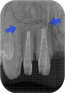 外科的歯内療法のケース（再根管治療）【治療後】