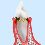 歯周病の症状と治療法
